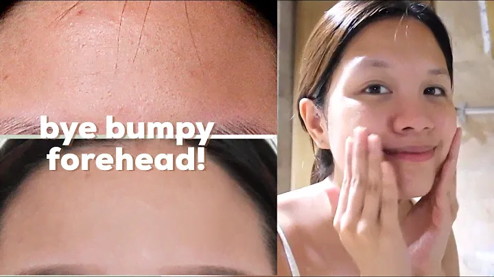 how I got rid of bumps on my forehead + brighter skin ft. COMMONLABS. Vitamin C Line