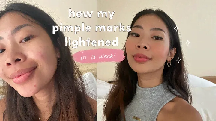 How my pimple marks LIGHTENED in a week!  | Rhea Bue